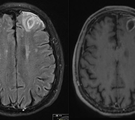 בדיקת mri פרטי לגבר בן 68 עם שאלה של אבסס מוחי