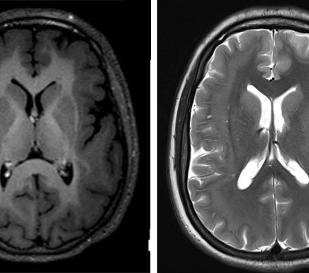 mri מוח של בחורה בת 20 לטיפול בפרכוסים