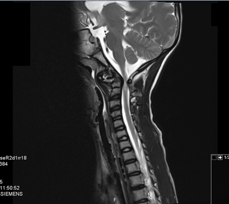 mri לילדה לאחר נפילה