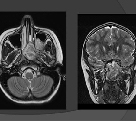 mri head of the 15-year-old boy