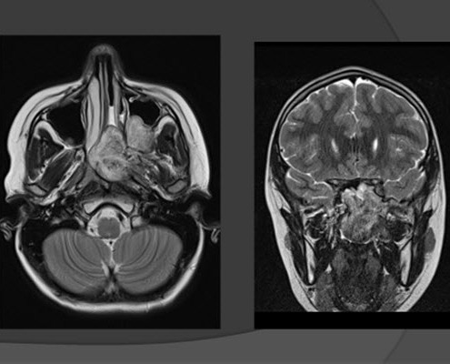 mri head of the 15-year-old boy