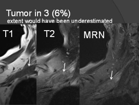 בדיקת MRI נוירוגרפיה