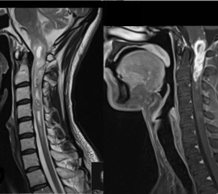 בדיקת MRI המדגימה תהליך בחוט הצווארי של נער בן 20