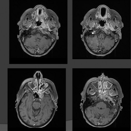 MRI מוח