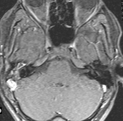 MRI כולסטאטומה