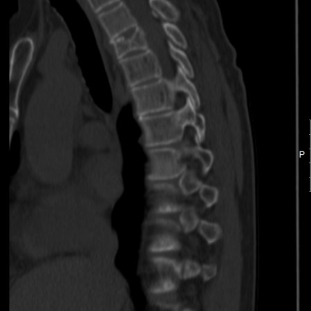 CT עמוד שדרה פענוח CT פענוח בדיקת CT