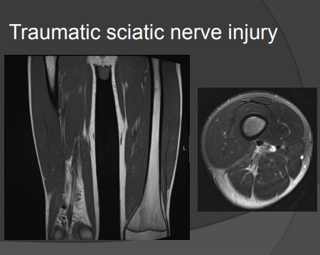mri test shows Traumatic sciatic nerve injury
