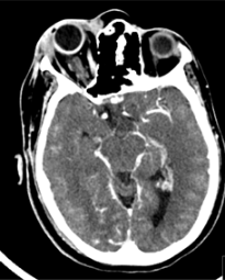 Blood vessels in eye sockets - ct