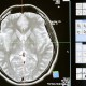 abscess in the brain - מורסה במוח